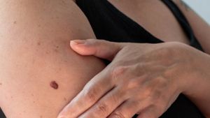 Frühwarnzeichen richtig deuten: Das ABCDE-Schema: So lässt sich Hautkrebs frühzeitig erkennen